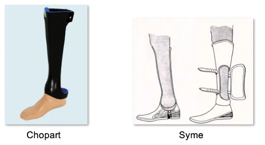 Chopart ve Syme Protezleri