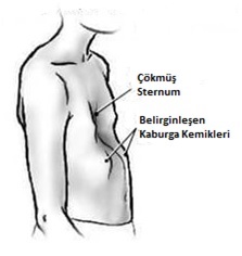 kariyer ortopedi-sternum
